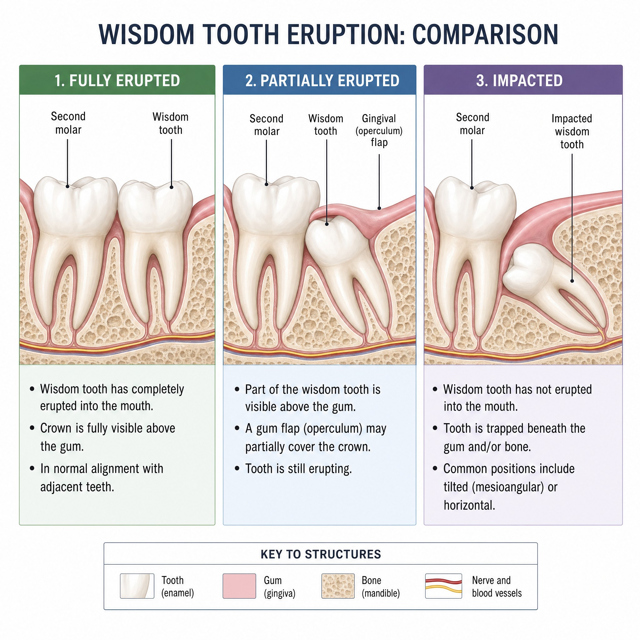 Diagram comparing fully erupted, partly erupted and impacted wisdom teeth